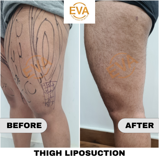 Liposuction Surgery